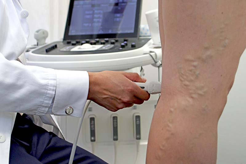 varices